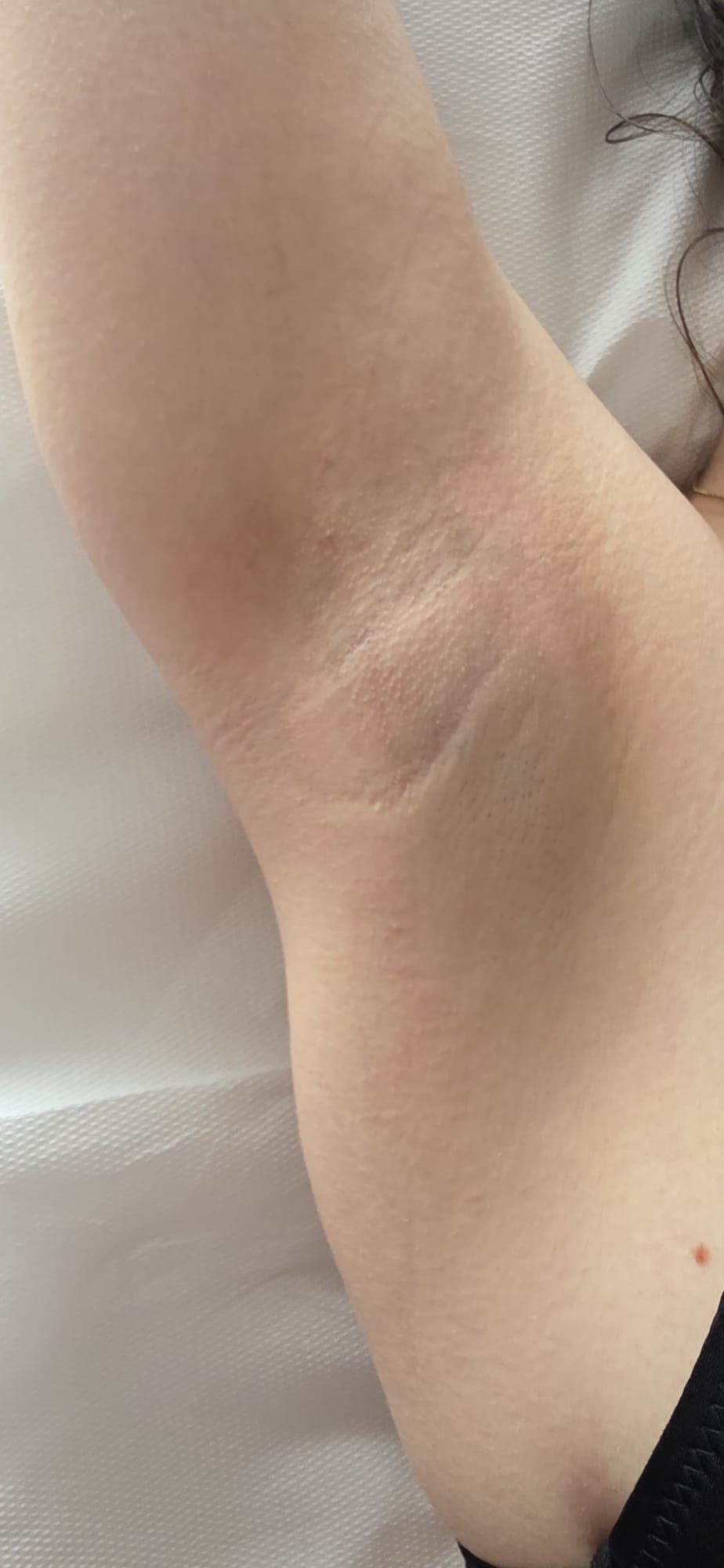 Epilare definitivă laser — axilă — După