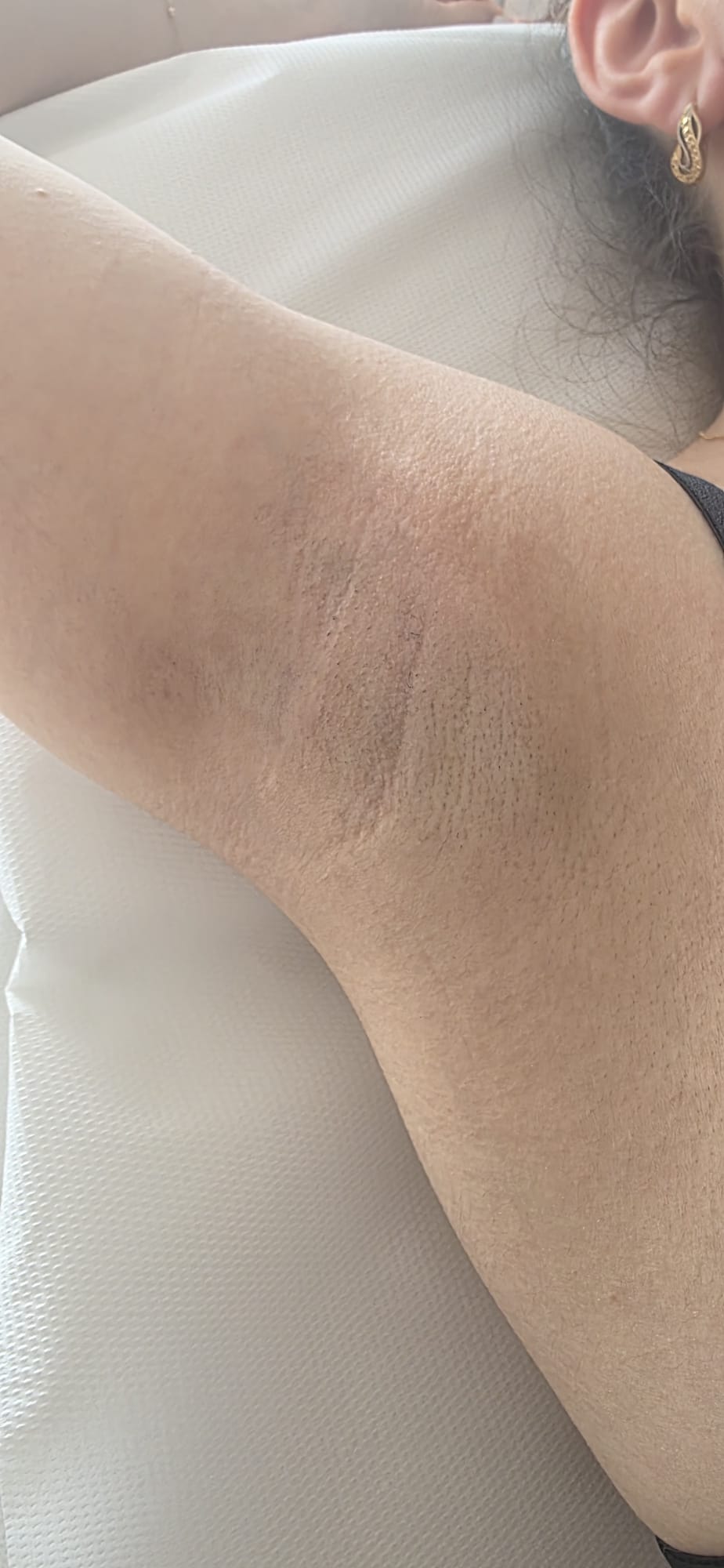 Epilare definitivă laser — axilă — Aprilie