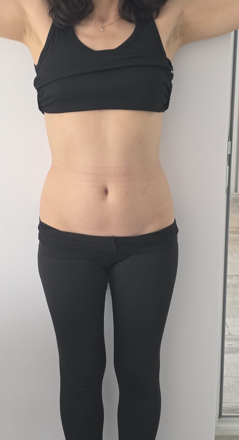 Liposonix — abdomen, rezultate suplimentare — După