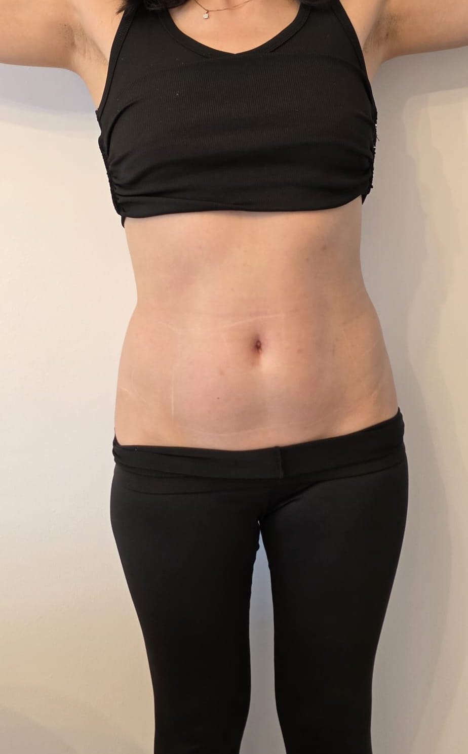 Liposonix — abdomen, rezultate suplimentare — Înainte
