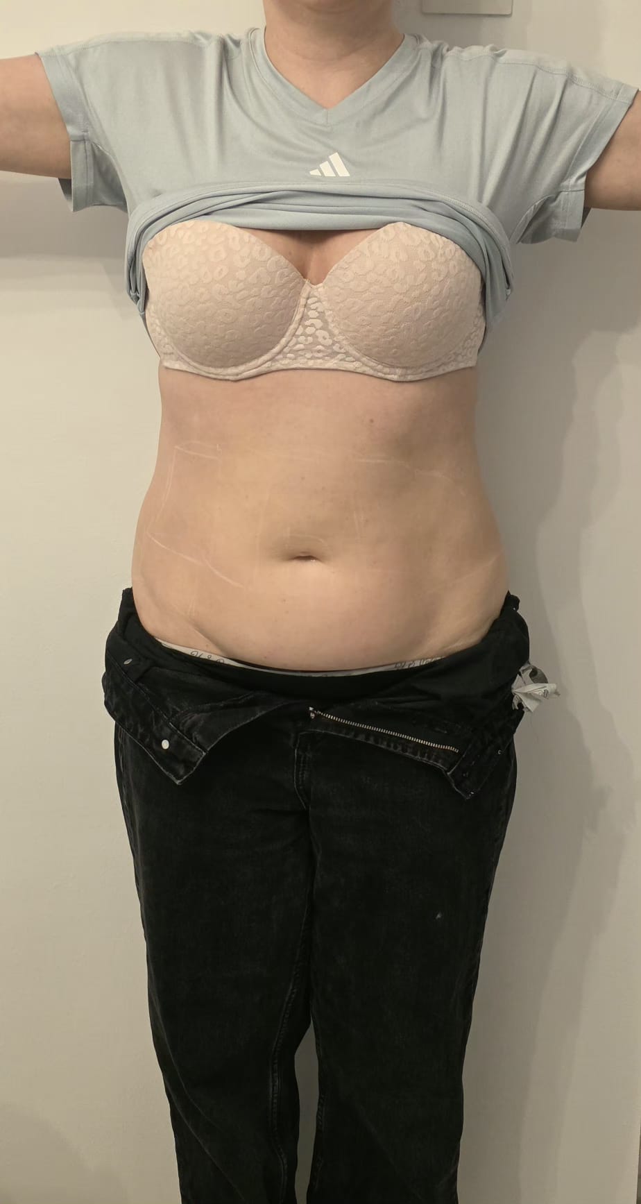 Liposonix — abdomen, vedere frontală — După