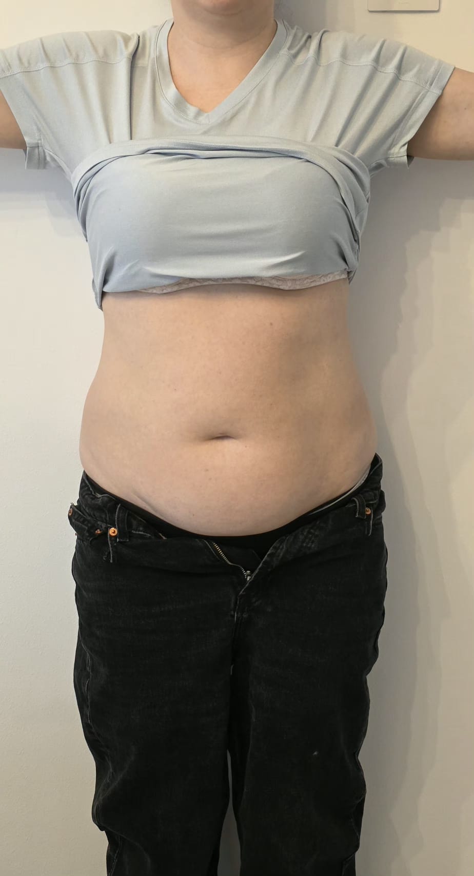 Liposonix — abdomen, vedere frontală — Înainte