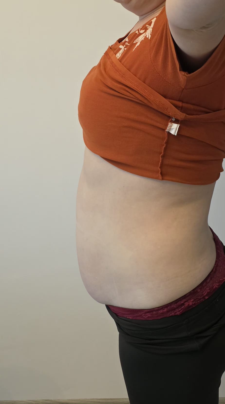 Liposonix — abdomen, profil lateral — După