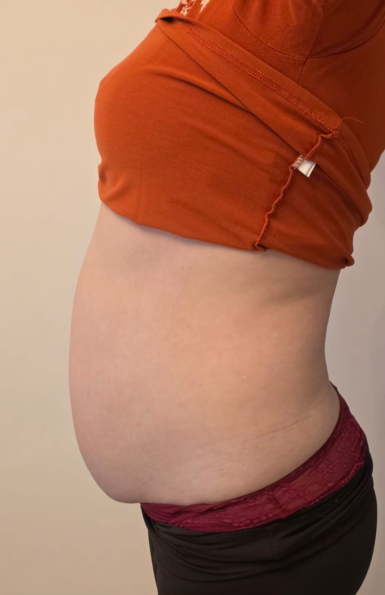 Liposonix — abdomen, profil lateral — Înainte
