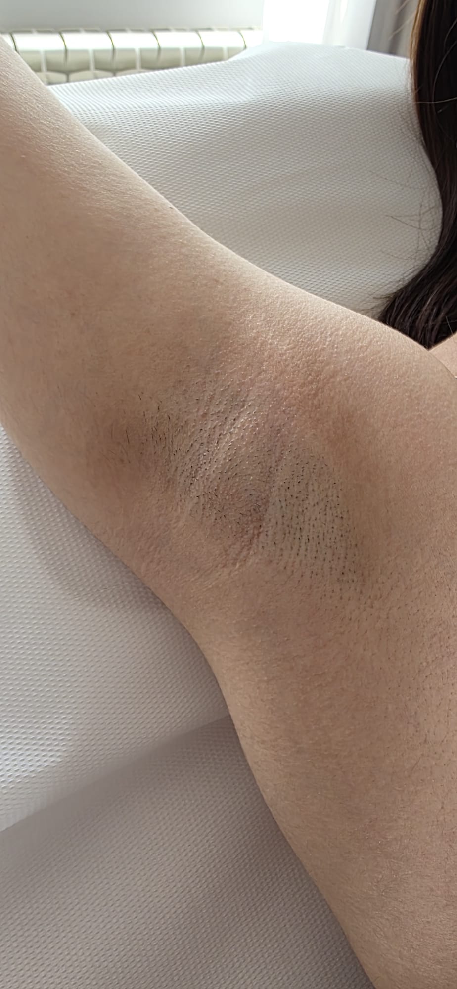 Epilare definitivă laser — axilă — Martie