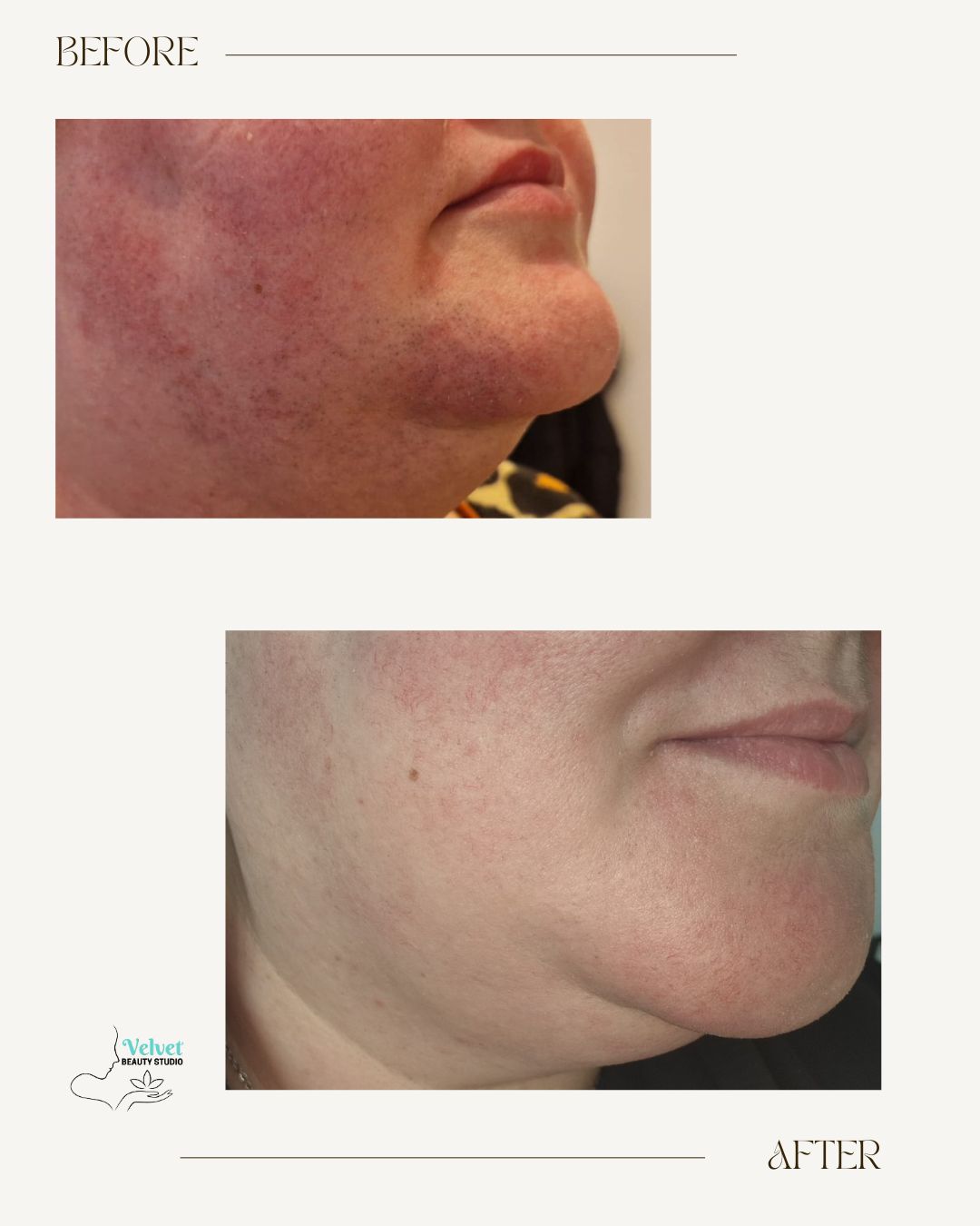 Rezultate față — Before & After